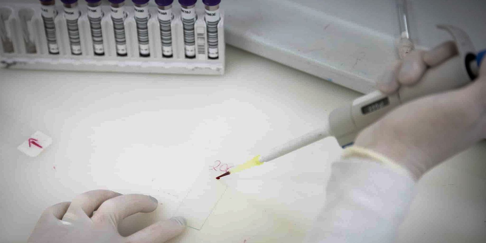 Paciente em SP com suspeita de ebola testa positivo para meningite